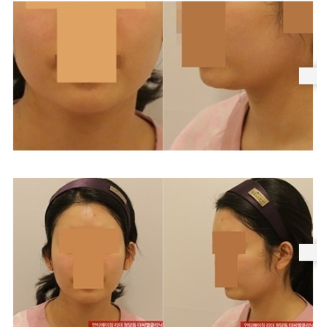 볼살 지방흡입 시술전