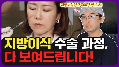 지방이식 하기 전 안 보면 100% 후회하는 영상 (얼굴지방이식 3,000건 집도한 의사의 노하우 大공개)