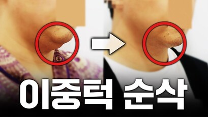 이중턱 지방흡입을 할 때 반드시 고려해야 할 사항 3가지