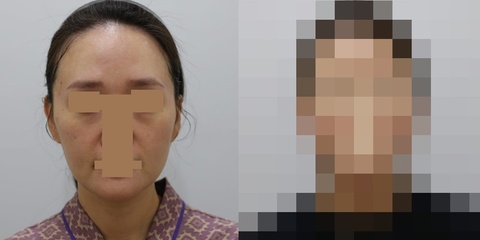 풀페이스 지방이식 1차 시술 1주일 후