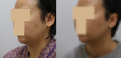 이중턱 지방흡입 1개월 전후사진